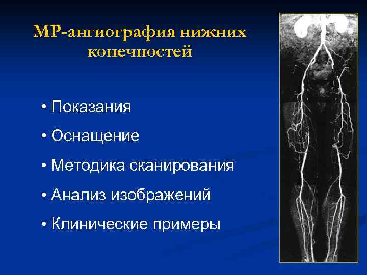 МР-ангиография нижних конечностей • Показания • Оснащение • Методика сканирования • Анализ изображений •