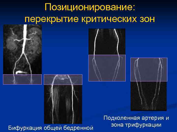 Позиционирование: перекрытие критических зон Бифуркация общей бедренной Подколенная артерия и зона трифуркации 