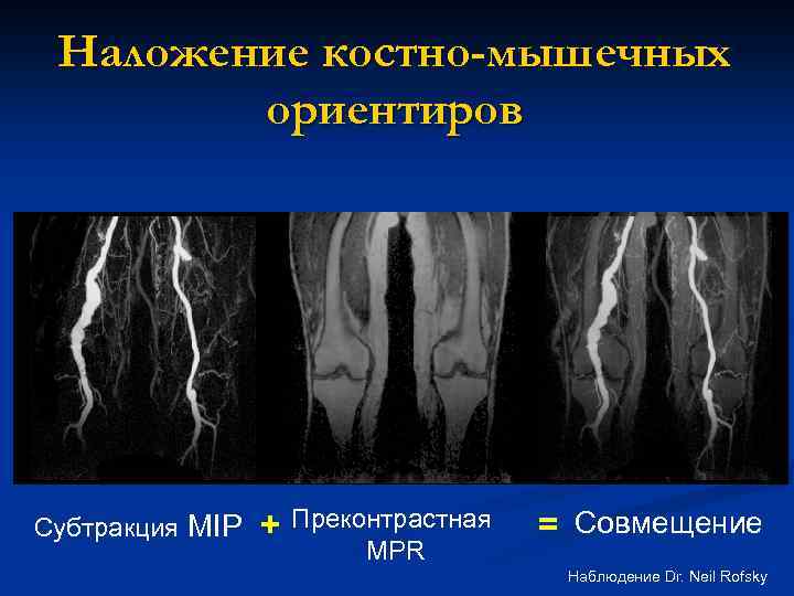 Наложение костно-мышечных ориентиров Субтракция MIP + Преконтрастная MPR = Совмещение Наблюдение Dr. Neil Rofsky