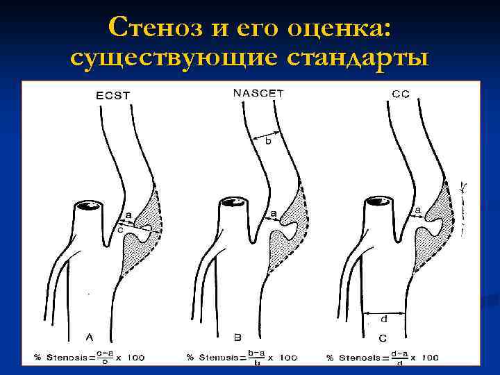 Стеноз и его оценка: существующие стандарты 