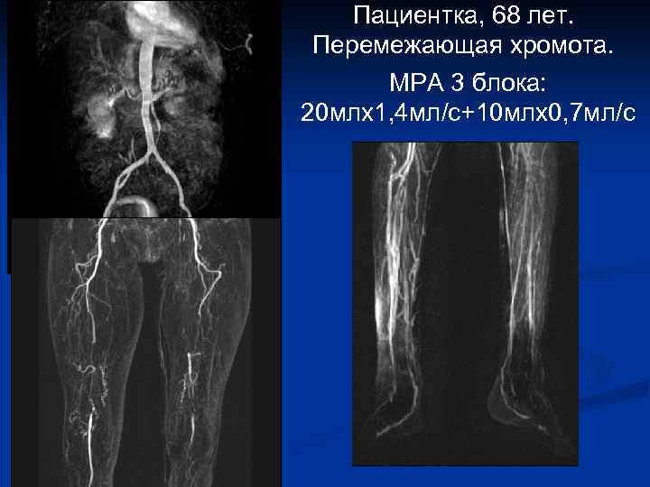 Пациентка, 68 лет. Перемежающая хромота. МРА 3 блока: 20 млх1, 4 мл/с+10 млх0, 7