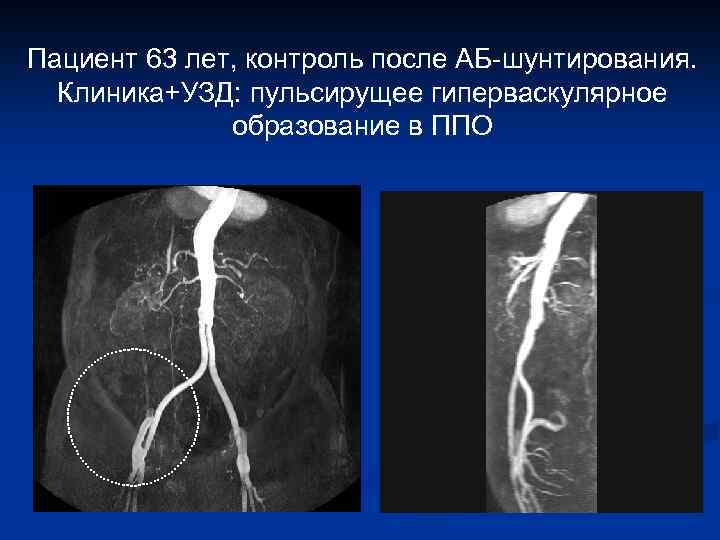 Пациент 63 лет, контроль после АБ-шунтирования. Клиника+УЗД: пульсирущее гиперваскулярное образование в ППО 