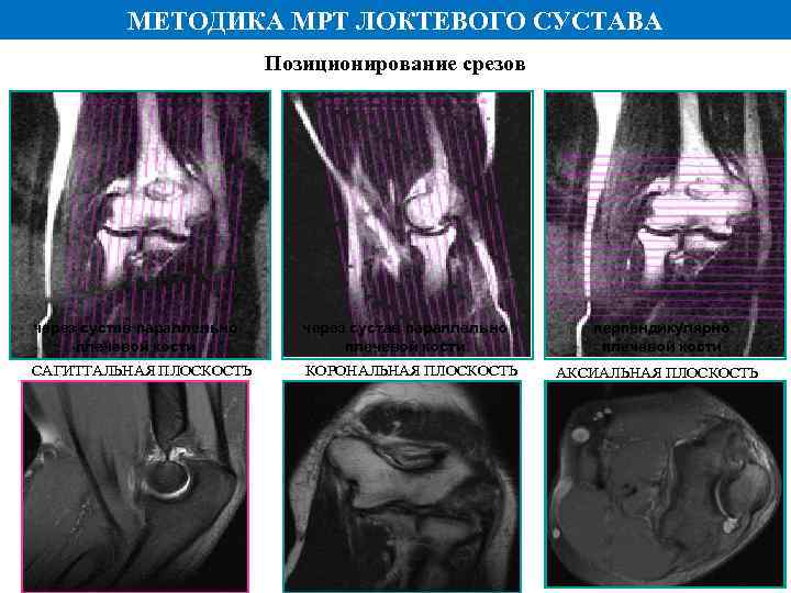 МЕТОДИКА МРТ ЛОКТЕВОГО СУСТАВА Позиционирование срезов через сустав параллельно плечевой кости САГИТТАЛЬНАЯ ПЛОСКОСТЬ КОРОНАЛЬНАЯ