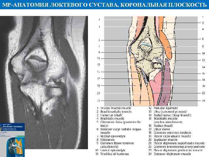 МР АНАТОМИЯ ЛОКТЕВОГО СУСТАВА, КОРОНАЛЬНАЯ ПЛОСКОСТЬ 