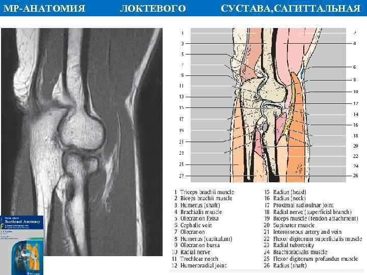 МР АНАТОМИЯ ПЛОСКОСТЬ ЛОКТЕВОГО СУСТАВА, САГИТТАЛЬНАЯ 