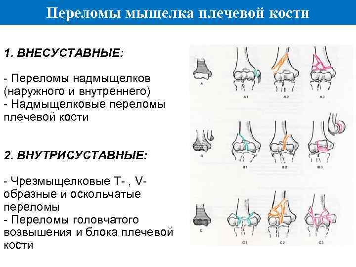 У образный перелом схема