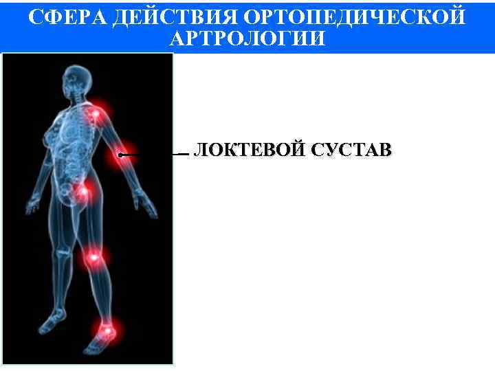 СФЕРА ДЕЙСТВИЯ ОРТОПЕДИЧЕСКОЙ АРТРОЛОГИИ ЛОКТЕВОЙ СУСТАВ 