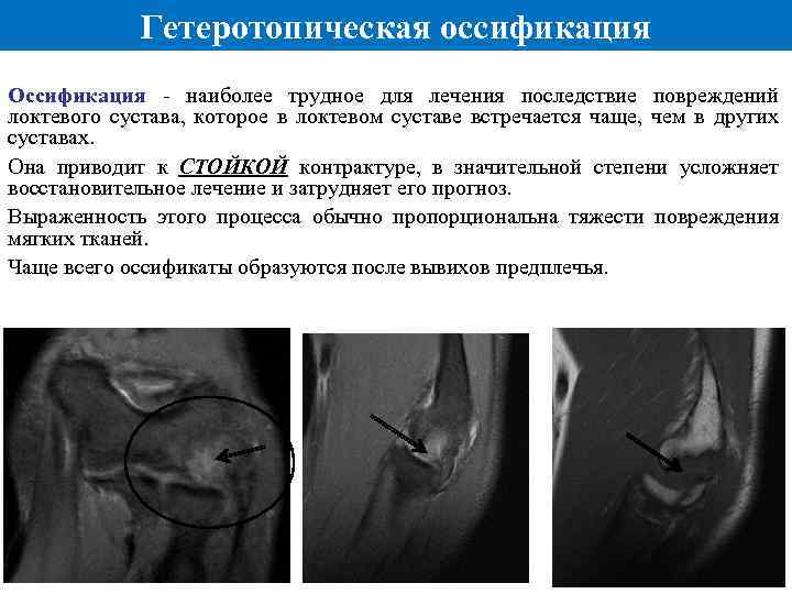 Гетеротопическая оссификация Оссификация - наиболее трудное для лечения последствие повреждений локтевого сустава, которое в