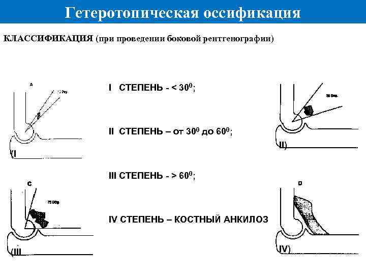 Гетеротопическая оссификация КЛАССИФИКАЦИЯ (при проведении боковой рентгенографии) I СТЕПЕНЬ - < 300; II СТЕПЕНЬ