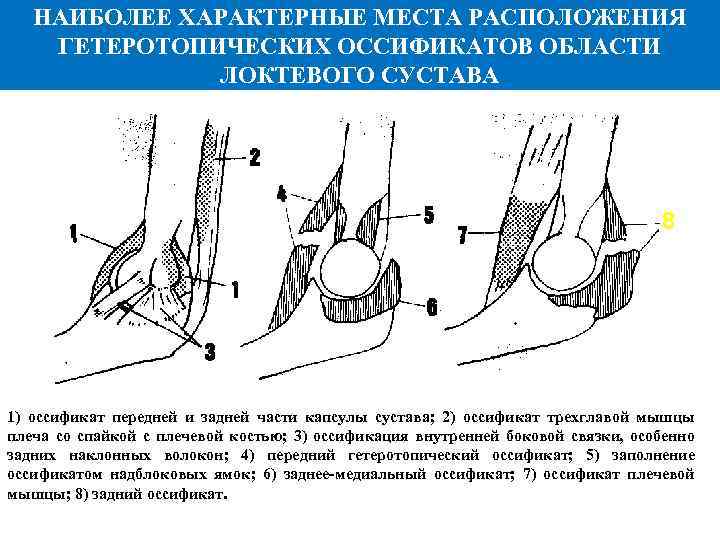НАИБОЛЕЕ ХАРАКТЕРНЫЕ МЕСТА РАСПОЛОЖЕНИЯ ГЕТЕРОТОПИЧЕСКИХ ОССИФИКАТОВ ОБЛАСТИ ЛОКТЕВОГО СУСТАВА 8 1) оссификат передней и