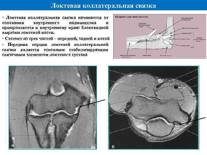 Локтевая коллатеральная связка • Локтевая коллатральная связка начинается от основания внутреннего надмыщелка и прикрепляется
