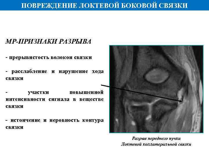 ПОВРЕЖДЕНИЕ ЛОКТЕВОЙ БОКОВОЙ СВЯЗКИ МР-ПРИЗНАКИ РАЗРЫВА - прерывистость волокон связки - расслабление и нарушение