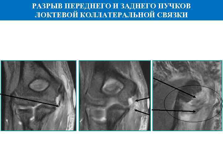 Разрыв переднего креста