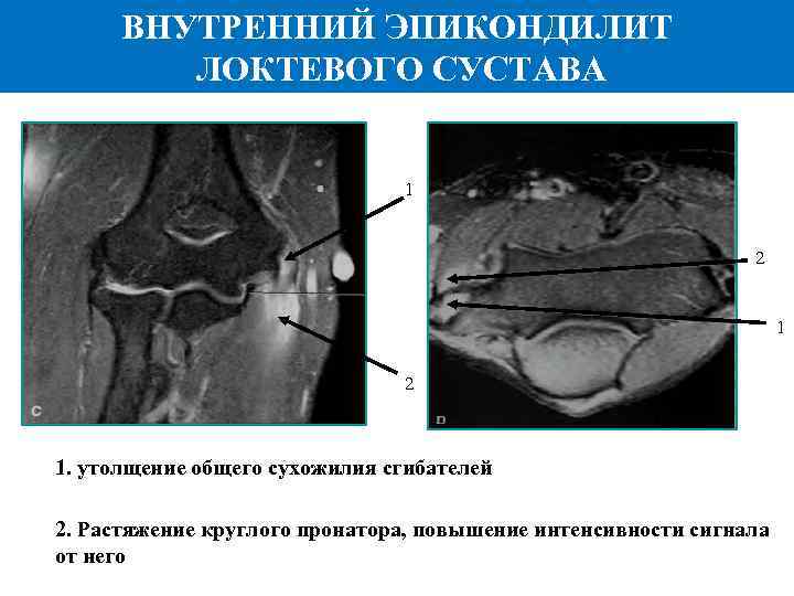 ВНУТРЕННИЙ ЭПИКОНДИЛИТ ЛОКТЕВОГО СУСТАВА 1 2 1. утолщение общего сухожилия сгибателей 2. Растяжение круглого