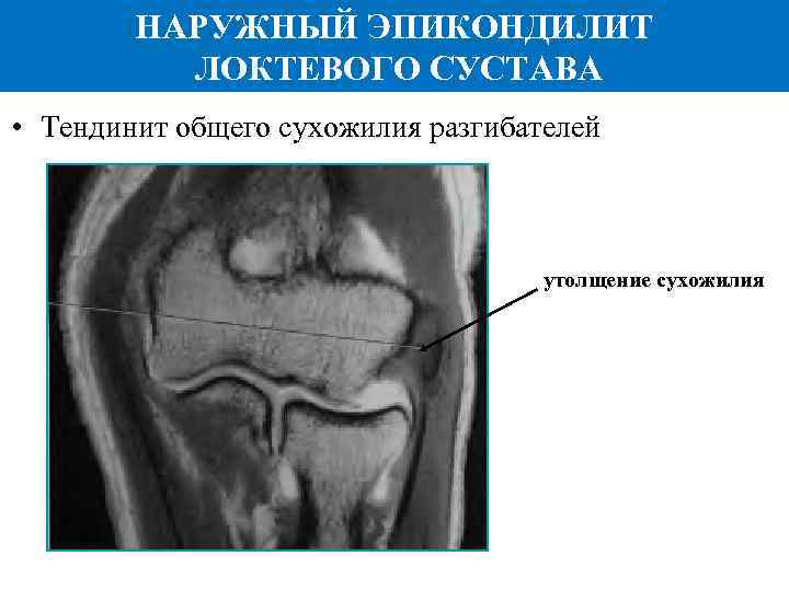 НАРУЖНЫЙ ЭПИКОНДИЛИТ ЛОКТЕВОГО СУСТАВА • Тендинит общего сухожилия разгибателей утолщение сухожилия 