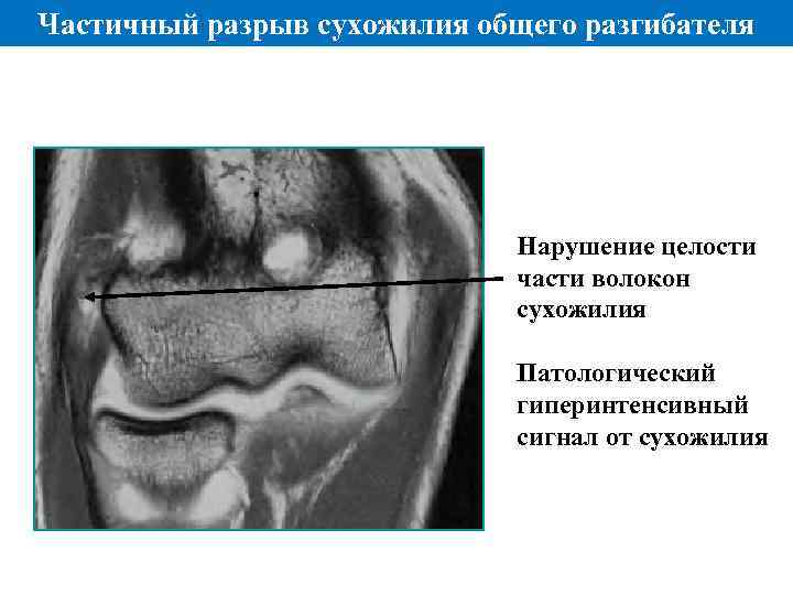 Частичный разрыв сухожилия общего разгибателя Нарушение целости части волокон сухожилия Патологический гиперинтенсивный сигнал от