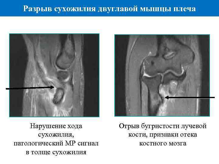 Ахиллесово сухожилие где находится на ноутбуке