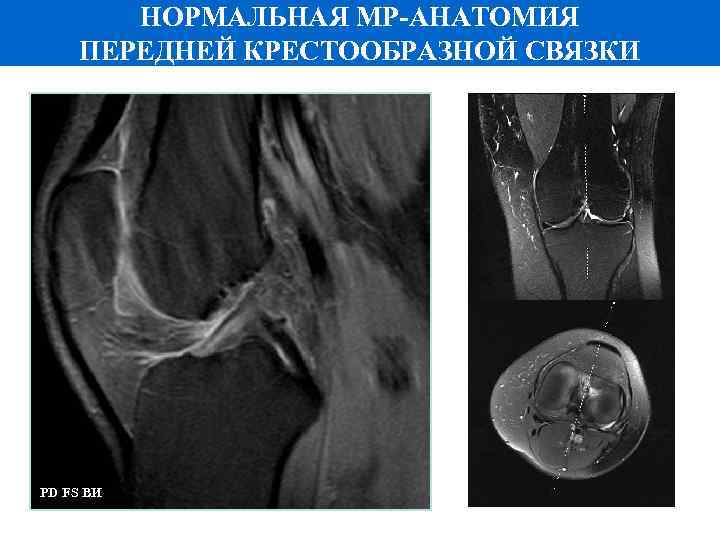 НОРМАЛЬНАЯ МР-АНАТОМИЯ ПЕРЕДНЕЙ КРЕСТООБРАЗНОЙ СВЯЗКИ PD FS ВИ 