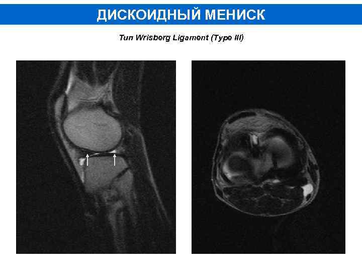 ДИСКОИДНЫЙ МЕНИСК Тип Wrisberg Ligament (Type III) 