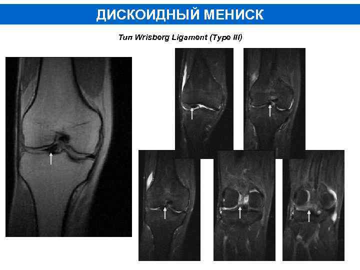 ДИСКОИДНЫЙ МЕНИСК Тип Wrisberg Ligament (Type III) 