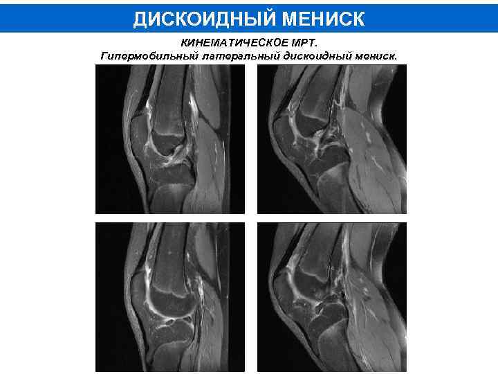 ДИСКОИДНЫЙ МЕНИСК КИНЕМАТИЧЕСКОЕ МРТ. Гипермобильный латеральный дискоидный мениск. 