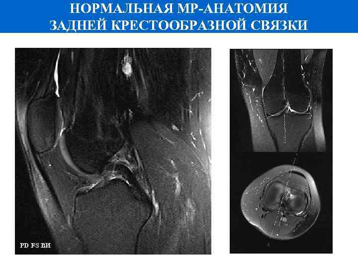 НОРМАЛЬНАЯ МР-АНАТОМИЯ ЗАДНЕЙ КРЕСТООБРАЗНОЙ СВЯЗКИ PD FS ВИ 