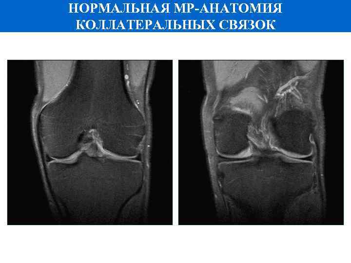 НОРМАЛЬНАЯ МР-АНАТОМИЯ КОЛЛАТЕРАЛЬНЫХ СВЯЗОК 