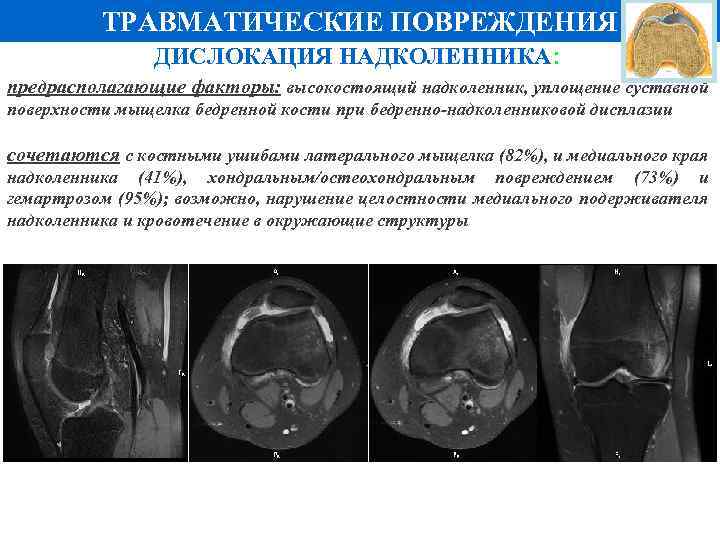 ТРАВМАТИЧЕСКИЕ ПОВРЕЖДЕНИЯ ДИСЛОКАЦИЯ НАДКОЛЕННИКА: предрасполагающие факторы: высокостоящий надколенник, уплощение суставной поверхности мыщелка бедренной кости