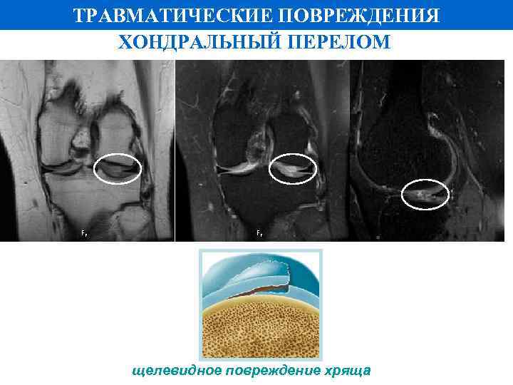 ТРАВМАТИЧЕСКИЕ ПОВРЕЖДЕНИЯ ХОНДРАЛЬНЫЙ ПЕРЕЛОМ щелевидное повреждение хряща 