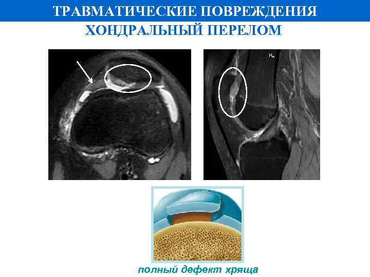 ТРАВМАТИЧЕСКИЕ ПОВРЕЖДЕНИЯ ХОНДРАЛЬНЫЙ ПЕРЕЛОМ полный дефект хряща 