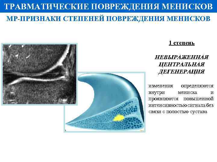 ТРАВМАТИЧЕСКИЕ ПОВРЕЖДЕНИЯ МЕНИСКОВ МР-ПРИЗНАКИ СТЕПЕНЕЙ ПОВРЕЖДЕНИЯ МЕНИСКОВ 1 степень НЕВЫРАЖЕННАЯ ЦЕНТРАЛЬНАЯ ДЕГЕНЕРАЦИЯ изменения определяются