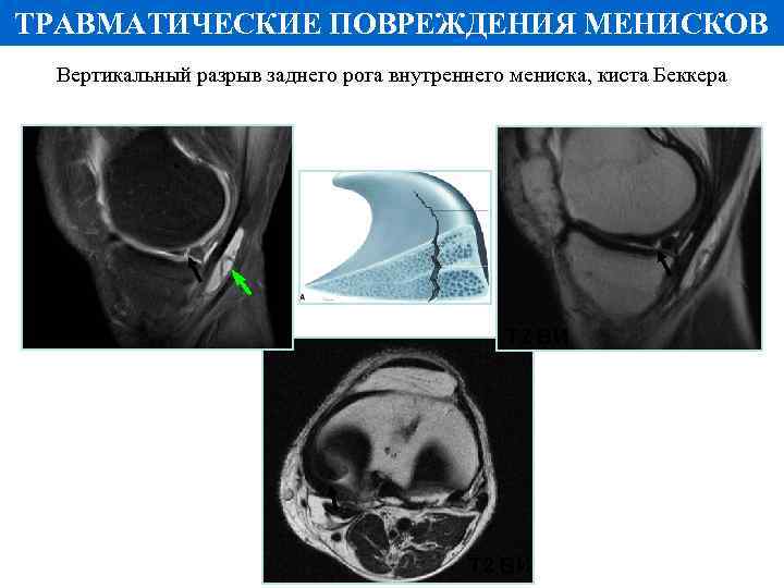 ТРАВМАТИЧЕСКИЕ ПОВРЕЖДЕНИЯ МЕНИСКОВ Вертикальный разрыв заднего рога внутреннего мениска, киста Беккера PD FS Т