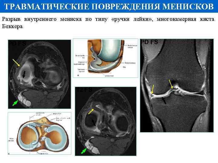 ТРАВМАТИЧЕСКИЕ ПОВРЕЖДЕНИЯ МЕНИСКОВ Разрыв внутреннего мениска по типу «ручки лейки» , многокамерная киста Беккера