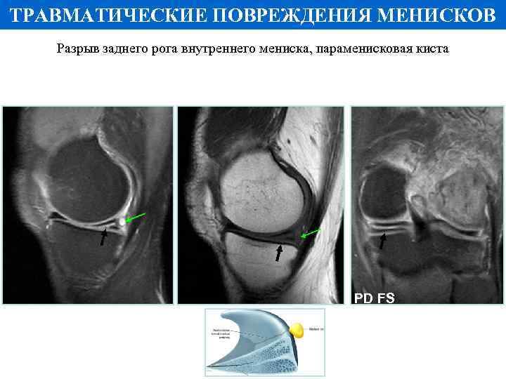 ТРАВМАТИЧЕСКИЕ ПОВРЕЖДЕНИЯ МЕНИСКОВ Разрыв заднего рога внутреннего мениска, параменисковая киста PD FS Т 1