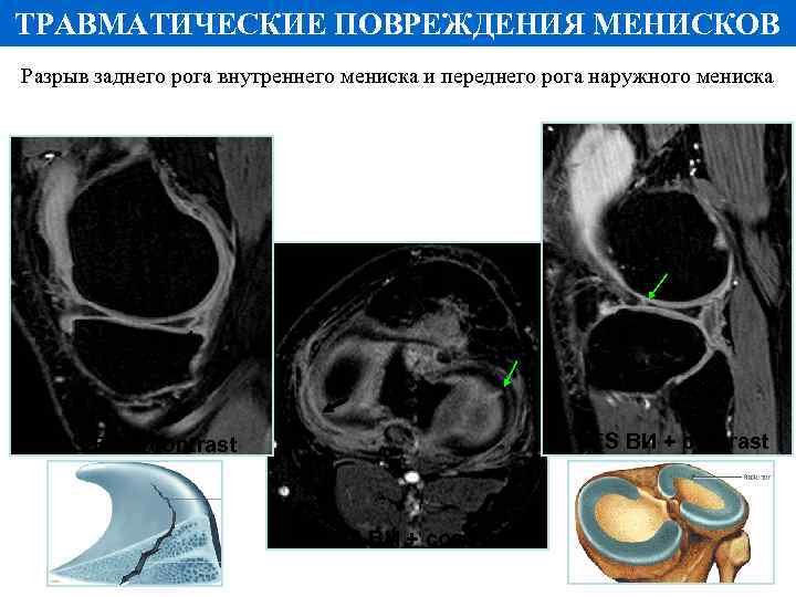 ТРАВМАТИЧЕСКИЕ ПОВРЕЖДЕНИЯ МЕНИСКОВ Разрыв заднего рога внутреннего мениска и переднего рога наружного мениска Т