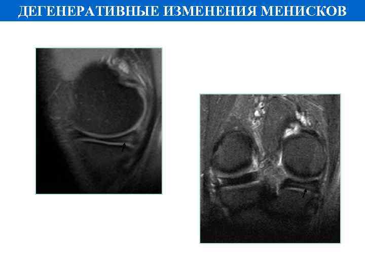 ДЕГЕНЕРАТИВНЫЕ ИЗМЕНЕНИЯ МЕНИСКОВ 