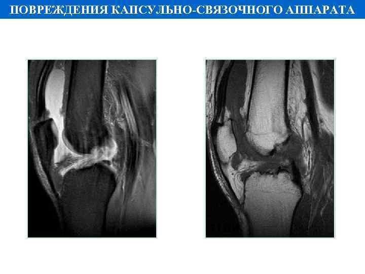 ПОВРЕЖДЕНИЯ КАПСУЛЬНО-СВЯЗОЧНОГО АППАРАТА PD FS Т 1 ВИ 