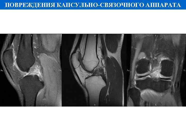 ПОВРЕЖДЕНИЯ КАПСУЛЬНО-СВЯЗОЧНОГО АППАРАТА 