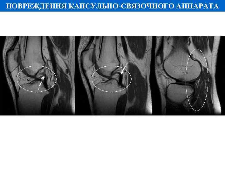 ПОВРЕЖДЕНИЯ КАПСУЛЬНО-СВЯЗОЧНОГО АППАРАТА 