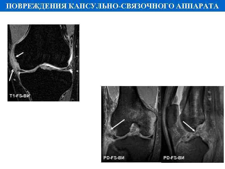 ПОВРЕЖДЕНИЯ КАПСУЛЬНО-СВЯЗОЧНОГО АППАРАТА Т 1 -FS-ВИ PD-FS-ВИ 