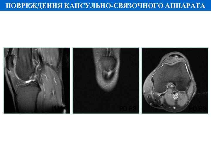 ПОВРЕЖДЕНИЯ КАПСУЛЬНО-СВЯЗОЧНОГО АППАРАТА PD FS 