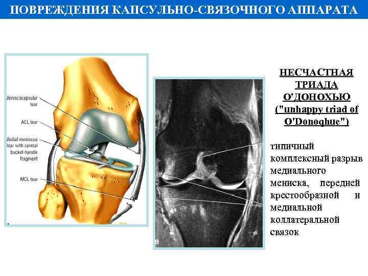 ПОВРЕЖДЕНИЯ КАПСУЛЬНО-СВЯЗОЧНОГО АППАРАТА НЕСЧАСТНАЯ ТРИАДА О'ДОНОХЬЮ (