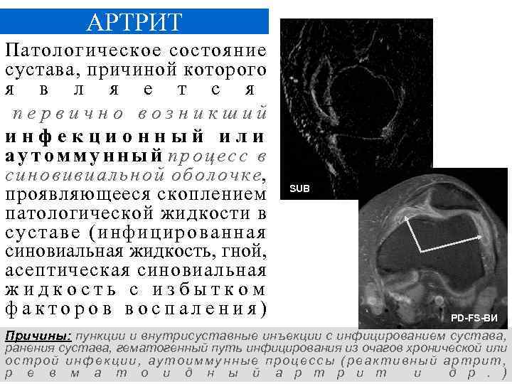 АРТРИТ Патологическое состояние сустава, причиной которого я в л я е т с я