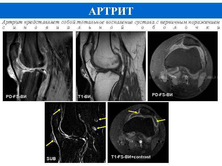 АРТРИТ Артрит представляет собой тотальное воспаление сустава с первичным поражением с и н о
