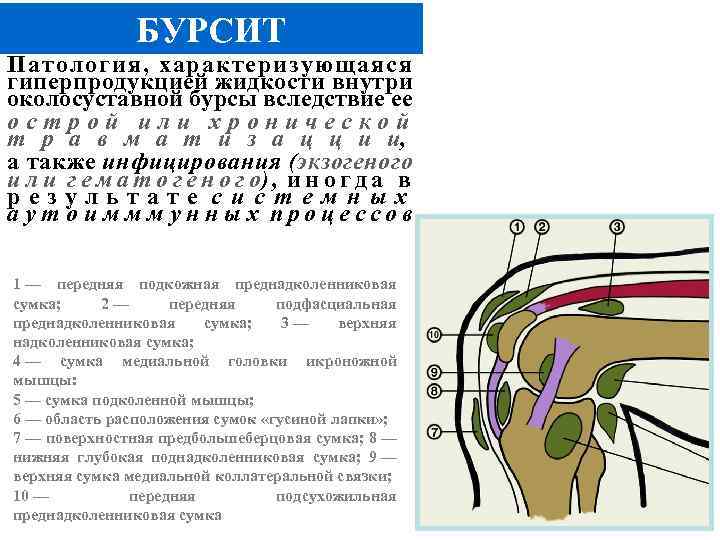 БУРСИТ Патология, характеризующаяся гиперпродукцией жидкости внутри околосуставной бурсы вследствие ее острой или хронической т