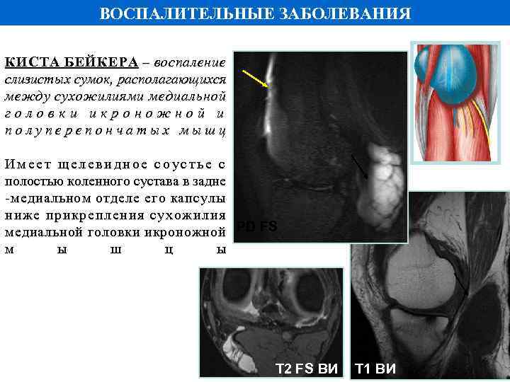 ВОСПАЛИТЕЛЬНЫЕ ЗАБОЛЕВАНИЯ КИСТА БЕЙКЕРА – воспаление слизистых сумок, располагающихся между сухожилиями медиальной головки икроножной