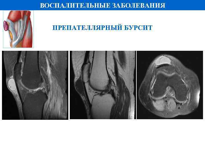 ВОСПАЛИТЕЛЬНЫЕ ЗАБОЛЕВАНИЯ ПРЕПАТЕЛЛЯРНЫЙ БУРСИТ PD FS 