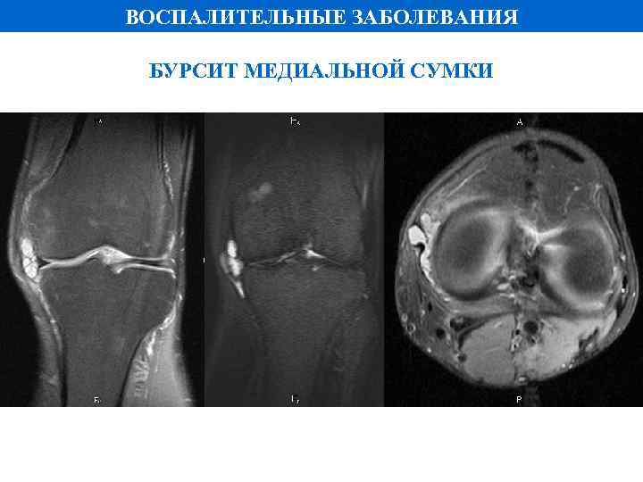 ВОСПАЛИТЕЛЬНЫЕ ЗАБОЛЕВАНИЯ БУРСИТ МЕДИАЛЬНОЙ СУМКИ PD FS 