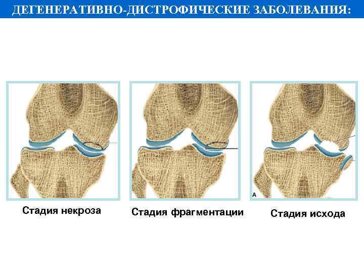 ДЕГЕНЕРАТИВНО-ДИСТРОФИЧЕСКИЕ ЗАБОЛЕВАНИЯ: Стадия некроза Стадия фрагментации Стадия исхода 