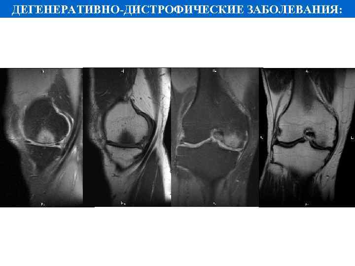 ДЕГЕНЕРАТИВНО-ДИСТРОФИЧЕСКИЕ ЗАБОЛЕВАНИЯ: 